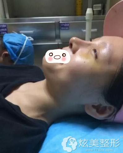 武汉美基元鼻综合整形拆线当天 武汉美基元鼻综合整形拆线当天