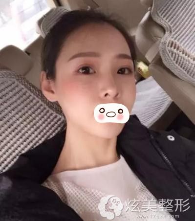 武汉美基元综合隆鼻15天的时候 武汉美基元综合隆鼻15天的时候