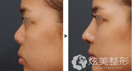 扬州施尔美6D全生态翘鼻术让短塌鼻立体挺翘 扬州施尔美6D全生态翘鼻术让短塌鼻立体挺翘