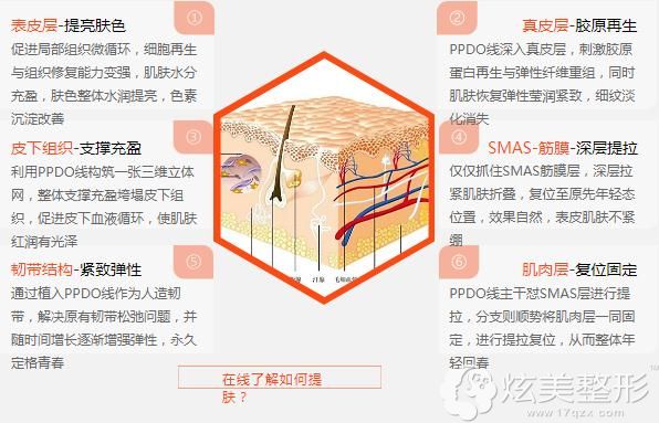 北京悦然PPDO线雕提拉术 北京悦然PPDO线雕提拉术
