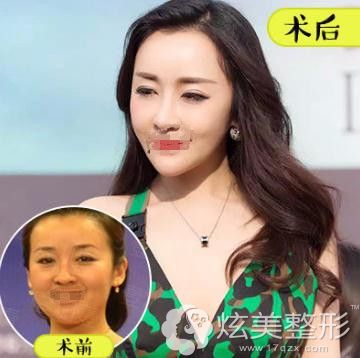 北京壹加壹蛋白线:埋下一根线,种出少女脸 北京壹加壹蛋白线:埋下一根线,种出少女脸