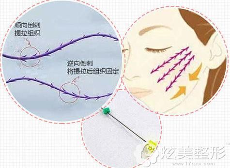 北京壹加壹蛋白线提拉 北京壹加壹蛋白线提拉