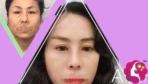 北京悦然PPDO线雕提拉术让大婶蜕变成女神 北京悦然PPDO线雕提拉术让大婶蜕变成女神