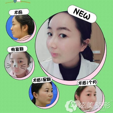 赵鹏医生的鼻综合手术案例 赵鹏医生的鼻综合手术案例