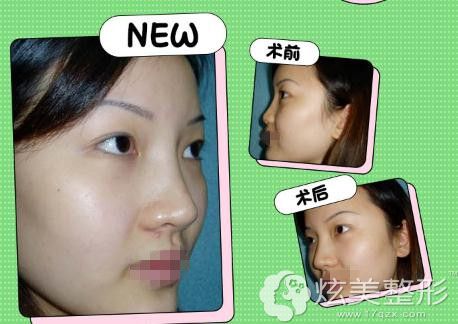 赵辑医生的鼻综合手术案例 赵辑医生的鼻综合手术案例