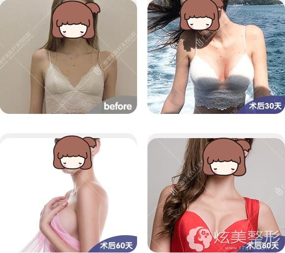 华美内窥镜丰胸深V 诱惑让我自信十足 华美内窥镜丰胸深V 诱惑让我自信十足