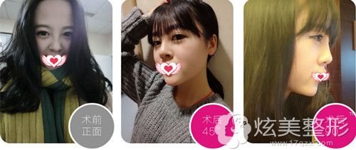 衡阳雅美鼻综合手术案例 衡阳雅美鼻综合手术案例