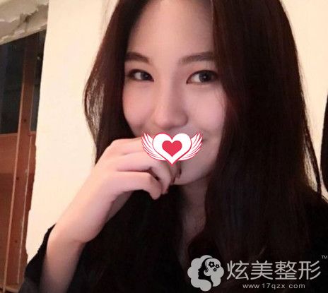 蔡亮主任做完线雕第2天面部整体效果很明显 蔡亮主任做完线雕第2天面部整体效果很明显