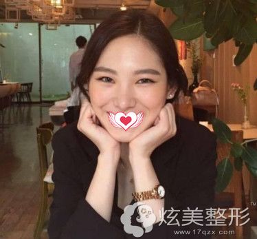蔡亮主任做埋线提升10天皮肤紧致许多 蔡亮主任做埋线提升10天皮肤紧致许多