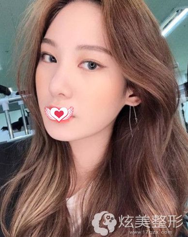 施尔美整形主任蔡亮做埋线提升18天面部光滑细嫩 施尔美整形主任蔡亮做埋线提升18天面部光滑细嫩