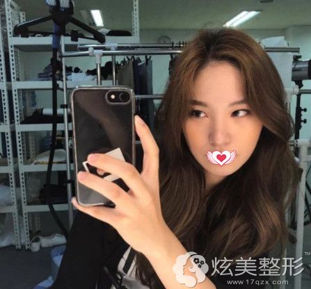 在常州施尔美做埋线提升术后1个月恢复自然 在常州施尔美做埋线提升术后1个月恢复自然