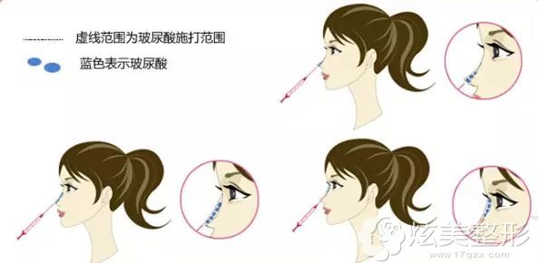 玻尿酸注射隆鼻原理图 玻尿酸注射隆鼻原理图