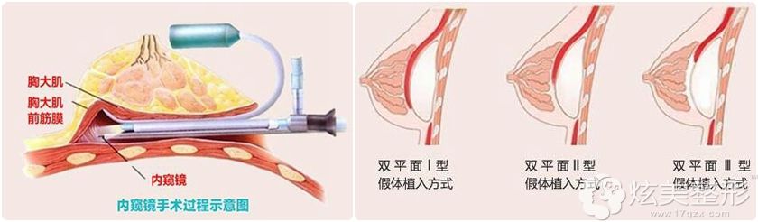 通过JCI认证的海南瑞韩在隆胸方面主推:宝岛荔枝胸技术 通过JCI认证的海南瑞韩在隆胸方面主推:宝岛荔枝胸技术