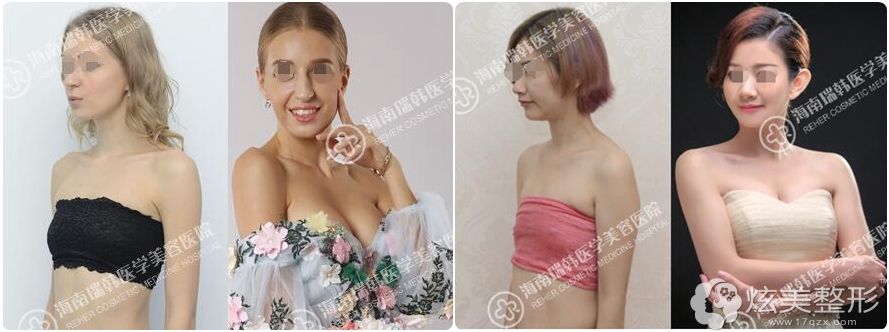 在海南瑞韩做假体隆胸术前术后对比案例 在海南瑞韩做假体隆胸术前术后对比案例