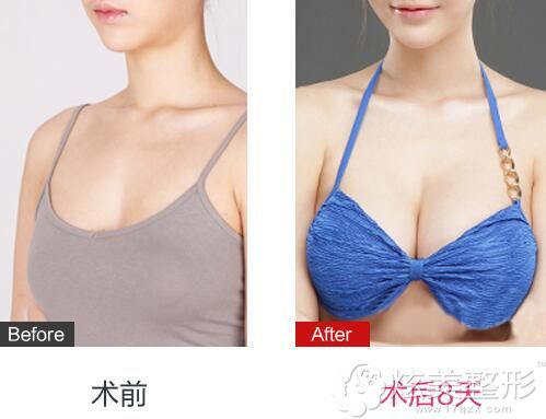 在郑州美丽时光隆胸前后对比照 在郑州美丽时光隆胸前后对比照