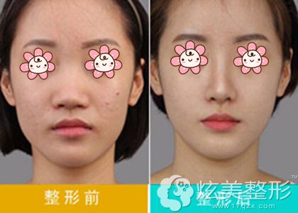 杨永成院长鼻头缩小术真人案例效果对比 杨永成院长鼻头缩小术真人案例效果对比