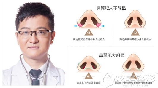 海口瑞韩整形缩鼻头手术原理图以及推荐医生杨永成 海口瑞韩整形缩鼻头手术原理图以及推荐医生杨永成