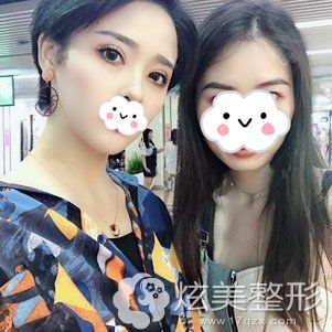术后125天自体脂肪面部填充恢复效果 术后125天自体脂肪面部填充恢复效果