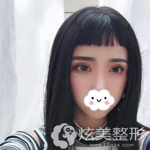 在济南瑞丽整形做面部填充术后30天肿胀消除 在济南瑞丽整形做面部填充术后30天肿胀消除