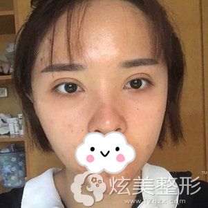 张敬花主任做自体脂肪面部填充术后7天拆线图 张敬花主任做自体脂肪面部填充术后7天拆线图