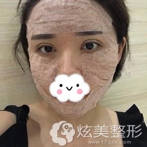 术后3天脸部肿胀但脸型饱满 术后3天脸部肿胀但脸型饱满