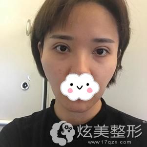 到济南瑞丽整形面诊前面部扁平的我 到济南瑞丽整形面诊前面部扁平的我