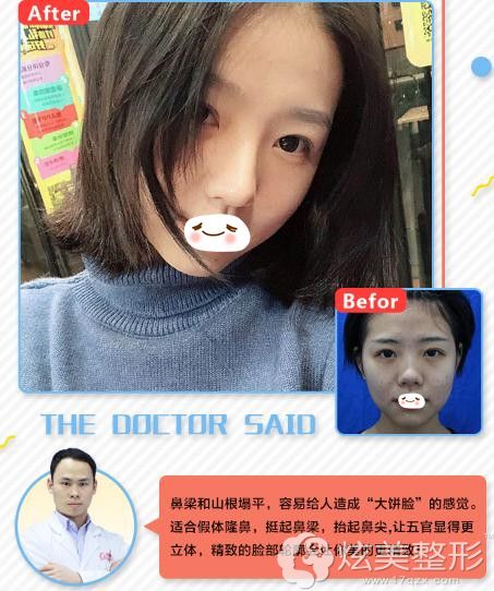 南昌时光假体隆鼻 南昌时光假体隆鼻