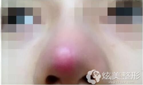 龙海波指出肋骨隆鼻尖过分追求挺翘效果就会出现过高发红情况 龙海波指出肋骨隆鼻尖过分追求挺翘效果就会出现过高发红情况