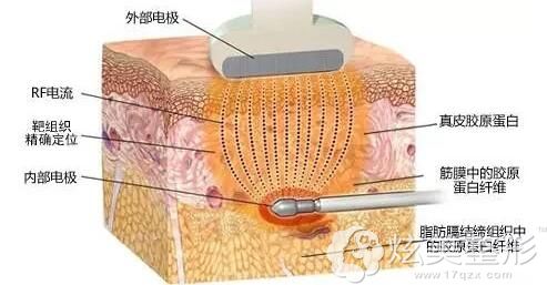 吸脂原理图解 吸脂原理图解