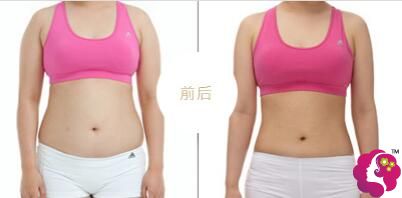 慈溪悦尔整形腰腹吸脂案例 慈溪悦尔整形腰腹吸脂案例