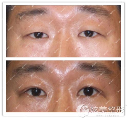 高罗镛院长眼综合案例 高罗镛院长眼综合案例