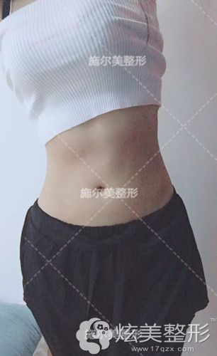 孙欣主任为我做腰腹吸脂术后20天展现小蛮腰 孙欣主任为我做腰腹吸脂术后20天展现小蛮腰