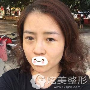 重庆华美激光祛眼袋术后当天 重庆华美激光祛眼袋术后当天