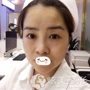 重庆华美激光祛眼袋术后第二天 重庆华美激光祛眼袋术后第二天