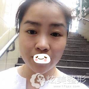 重庆华美激光祛眼袋术后第三天 重庆华美激光祛眼袋术后第三天