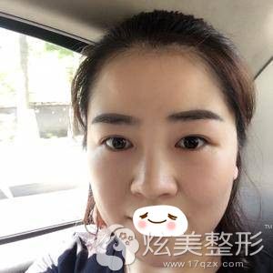 重庆华美激光祛眼袋术后第五天 重庆华美激光祛眼袋术后第五天