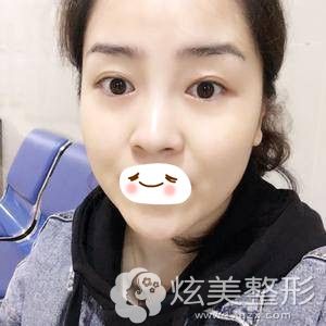 重庆华美激光祛眼袋术后一周恢复自然 重庆华美激光祛眼袋术后一周恢复自然