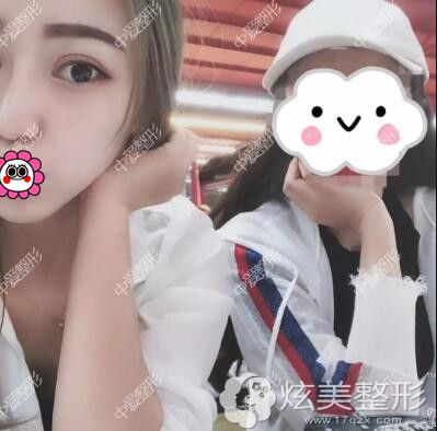 术后半个月黄石中爱分享眼鼻恢复情况 术后半个月黄石中爱分享眼鼻恢复情况