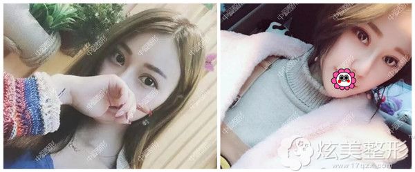 到黄石中爱做眼鼻综合整形素颜和上妆效果 到黄石中爱做眼鼻综合整形素颜和上妆效果
