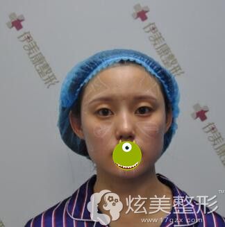 术前面部肌肤松弛 术前面部肌肤松弛
