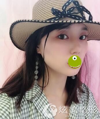 除皱术后一个月 除皱术后一个月