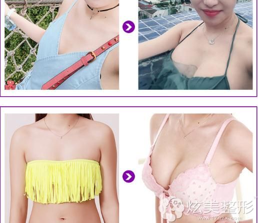 北京米兰柏羽丽都内窥镜定制假体隆胸<span alt=