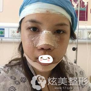 广州美莱鼻综合加假体垫下巴术后当天 广州美莱鼻综合加假体垫下巴术后当天