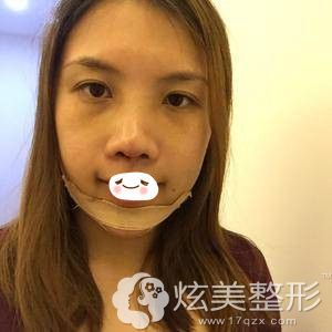 广州美莱鼻综合加假体垫下巴术后一周 广州美莱鼻综合加假体垫下巴术后一周