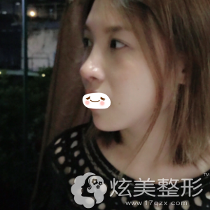 广州美莱鼻综合加假体垫下巴术后一个月 广州美莱鼻综合加假体垫下巴术后一个月