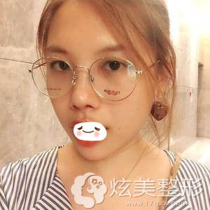 广州美莱鼻综合加假体垫下巴术后2个月 广州美莱鼻综合加假体垫下巴术后2个月