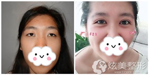 张院长做眼综合整形术后恢复效果 张院长做眼综合整形术后恢复效果