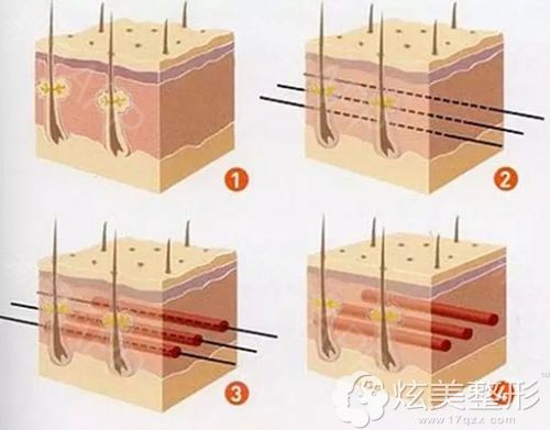 深圳美莱整形做面部埋线提升手术步骤简易图 深圳美莱整形做面部埋线提升手术步骤简易图
