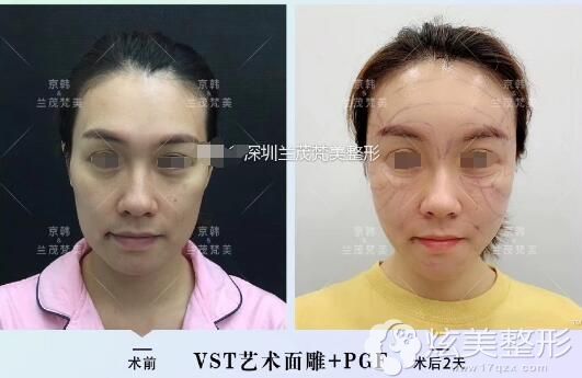 郭尚琴医生整形案例 郭尚琴医生整形案例
