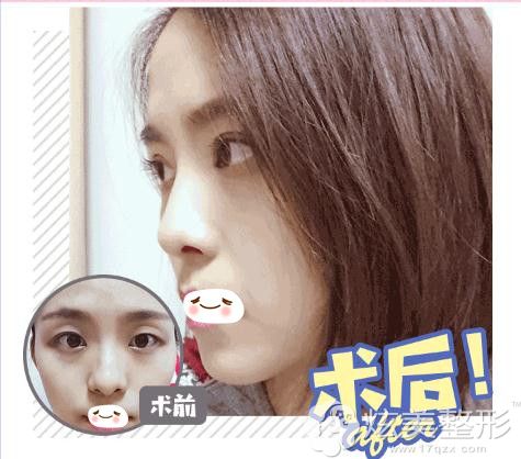 陈磊医生双眼皮整形真人案例图 陈磊医生双眼皮整形真人案例图